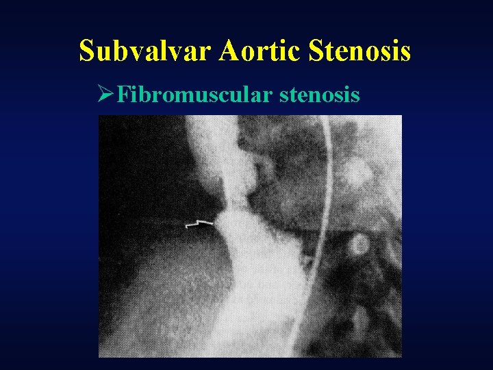 Subvalvar Aortic Stenosis ØFibromuscular stenosis 