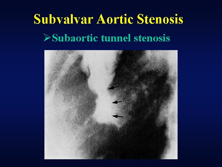 Subvalvar Aortic Stenosis ØSubaortic tunnel stenosis 
