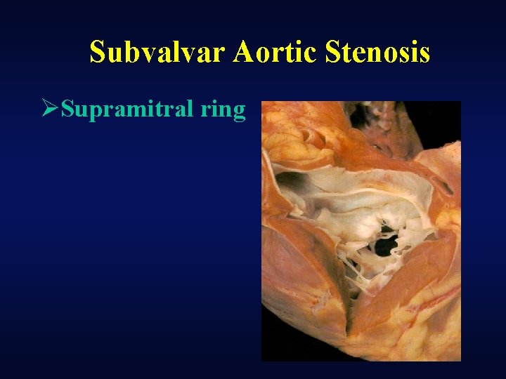 Subvalvar Aortic Stenosis ØSupramitral ring 