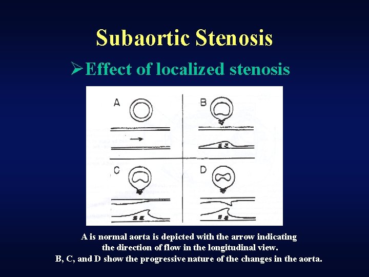 Subaortic Stenosis ØEffect of localized stenosis A is normal aorta is depicted with the
