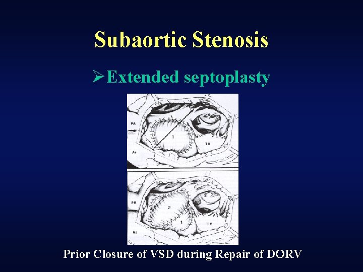 Subaortic Stenosis ØExtended septoplasty Prior Closure of VSD during Repair of DORV 
