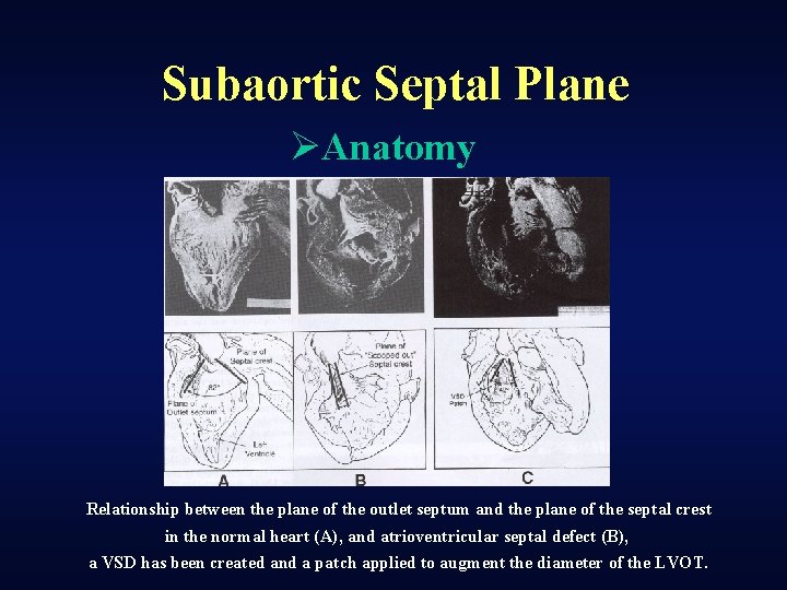 Subaortic Septal Plane ØAnatomy Relationship between the plane of the outlet septum and the
