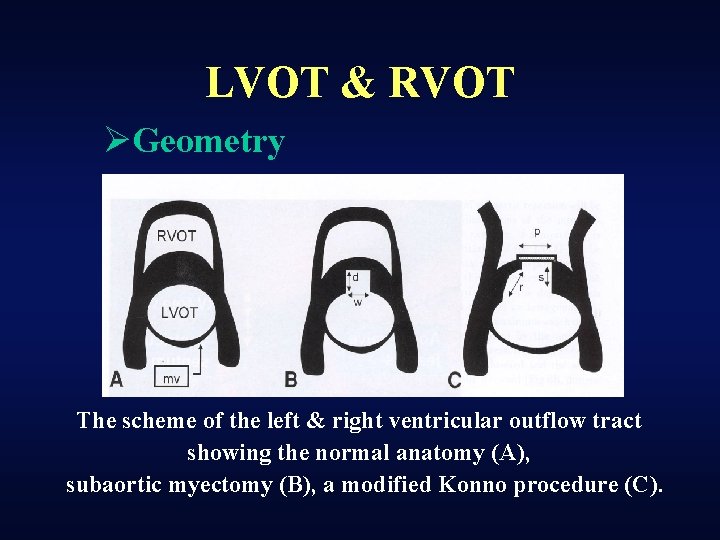 LVOT & RVOT ØGeometry The scheme of the left & right ventricular outflow tract