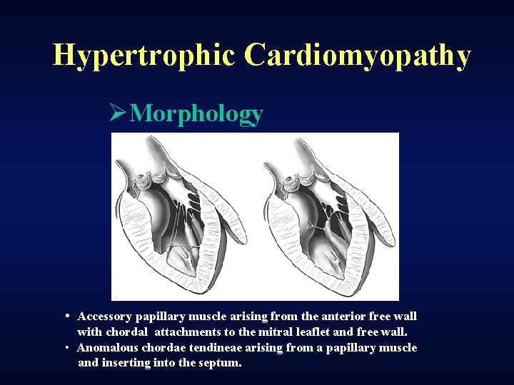 Hypertrophic Cardiomyopathy ØMorphology • Accessory papillary muscle arising from the anterior free wall with