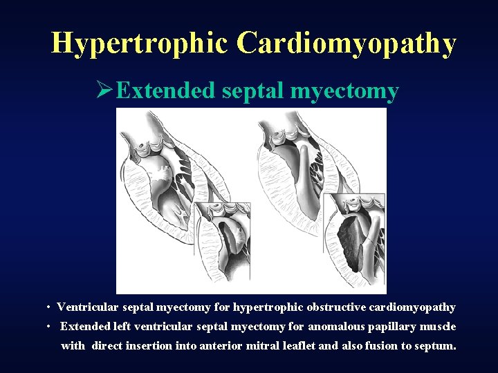 Hypertrophic Cardiomyopathy ØExtended septal myectomy • Ventricular septal myectomy for hypertrophic obstructive cardiomyopathy •