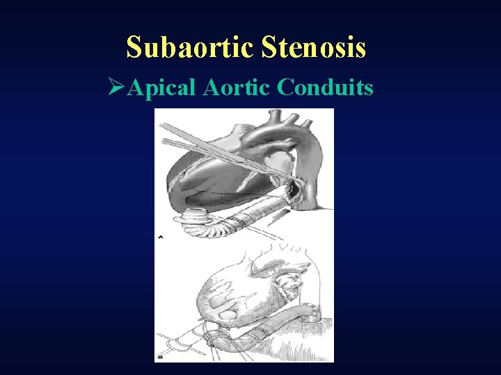 Subaortic Stenosis ØApical Aortic Conduits 
