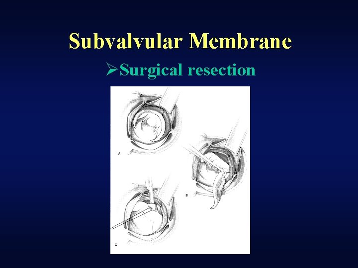 Subvalvular Membrane ØSurgical resection 
