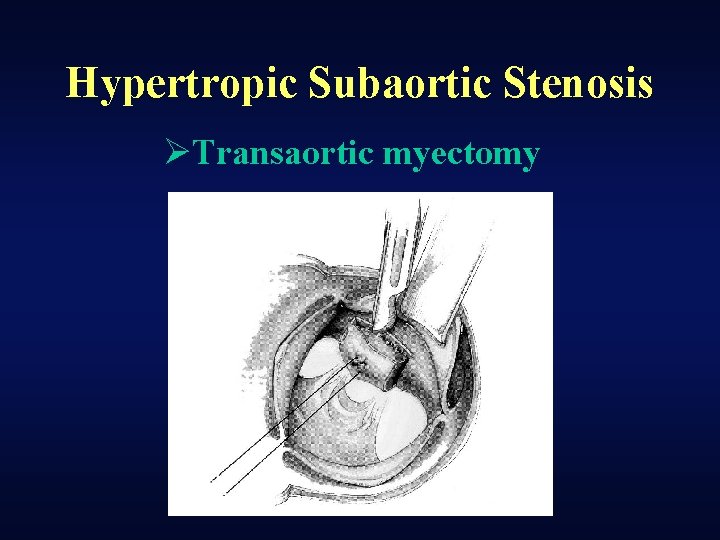 Hypertropic Subaortic Stenosis ØTransaortic myectomy 