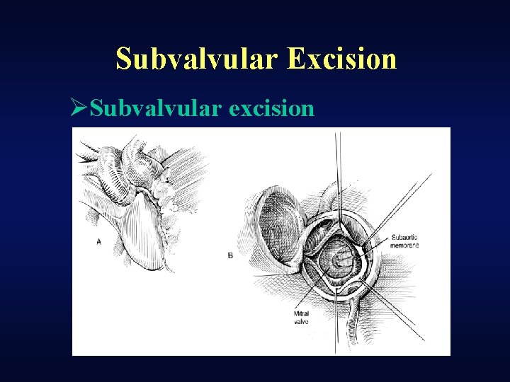 Subvalvular Excision ØSubvalvular excision 