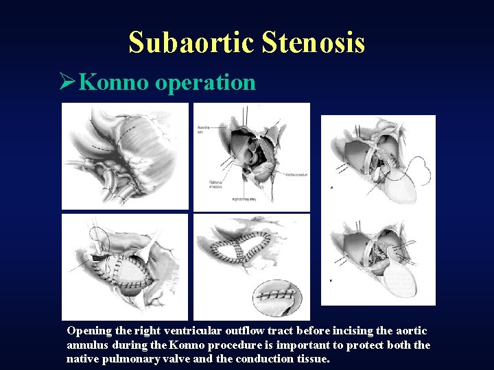 Subaortic Stenosis ØKonno operation Opening the right ventricular outflow tract before incising the aortic