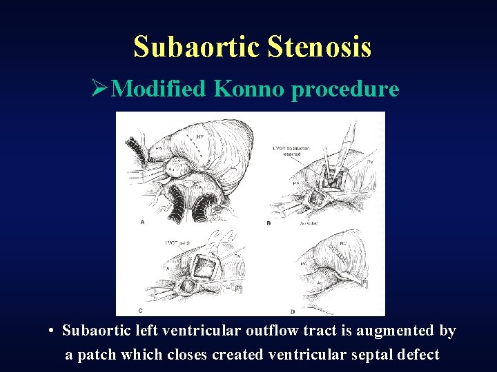 Subaortic Stenosis ØModified Konno procedure • Subaortic left ventricular outflow tract is augmented by