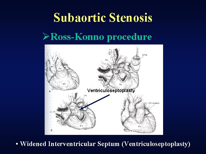 Subaortic Stenosis ØRoss-Konno procedure Ventriculoseptoplasty • Widened Interventricular Septum (Ventriculoseptoplasty) 