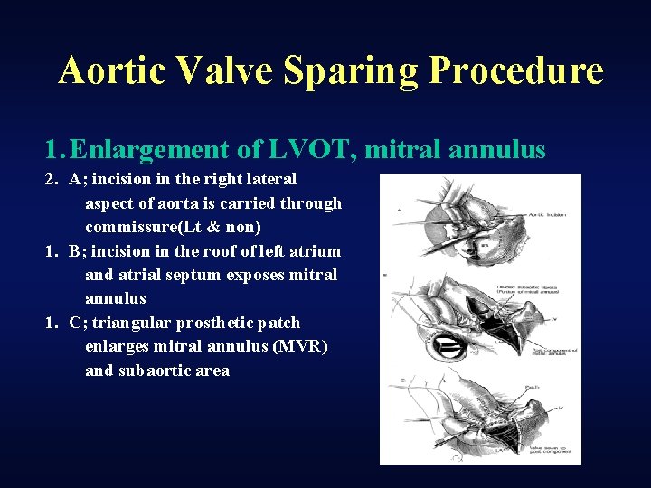 Aortic Valve Sparing Procedure 1. Enlargement of LVOT, mitral annulus 2. A; incision in