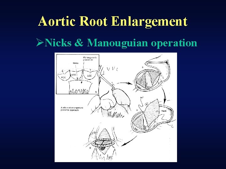 Aortic Root Enlargement ØNicks & Manouguian operation 