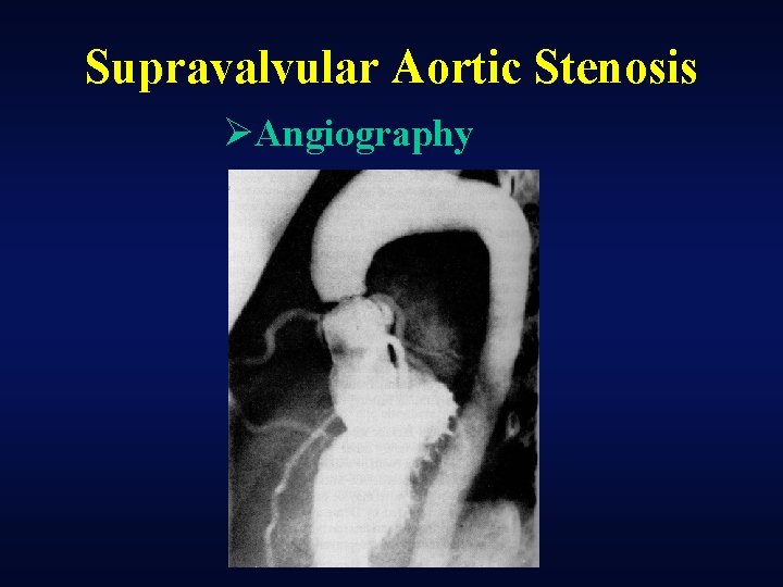 Supravalvular Aortic Stenosis ØAngiography 