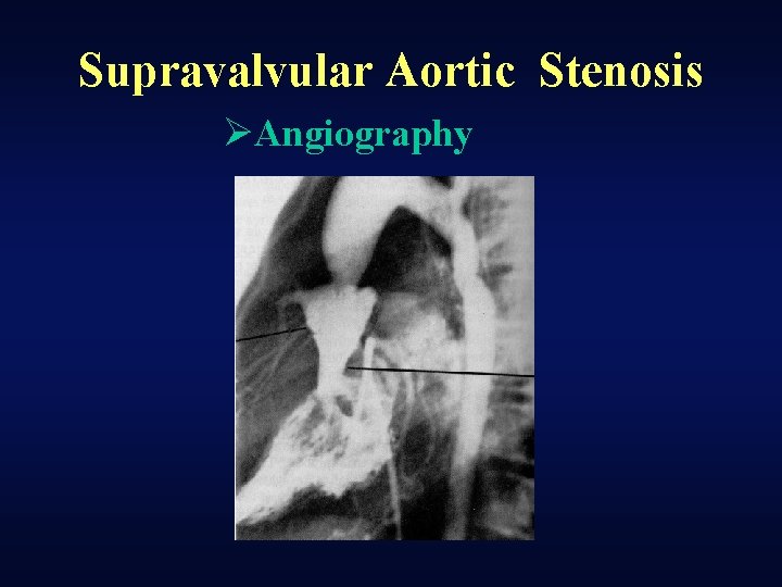 Supravalvular Aortic Stenosis ØAngiography 