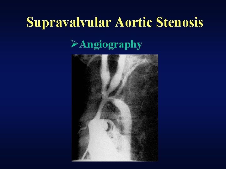 Supravalvular Aortic Stenosis ØAngiography 