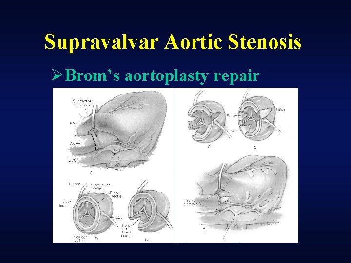 Supravalvar Aortic Stenosis ØBrom’s aortoplasty repair 