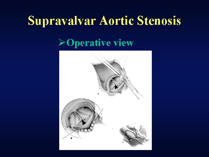 Supravalvar Aortic Stenosis ØOperative view 