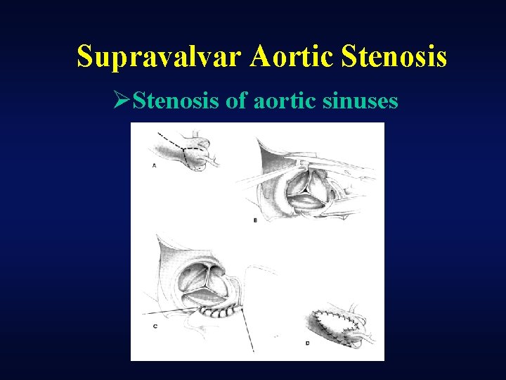 Supravalvar Aortic Stenosis ØStenosis of aortic sinuses 