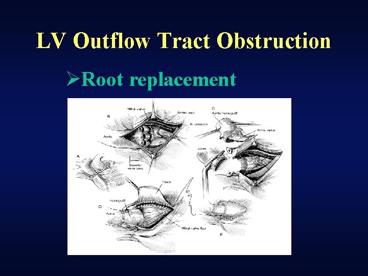 LV Outflow Tract Obstruction ØRoot replacement 