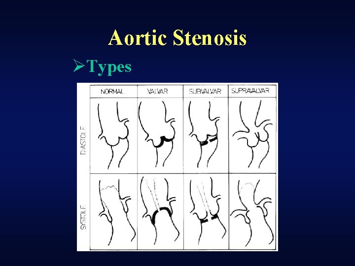 Aortic Stenosis ØTypes 