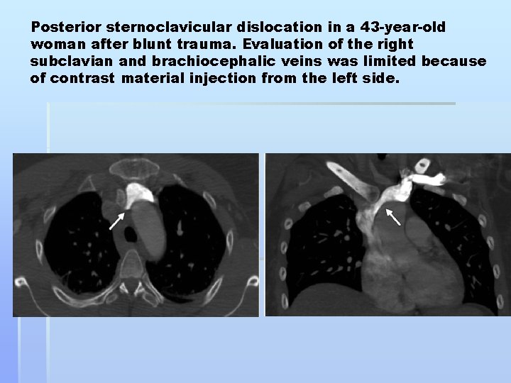 Posterior sternoclavicular dislocation in a 43 -year-old woman after blunt trauma. Evaluation of the