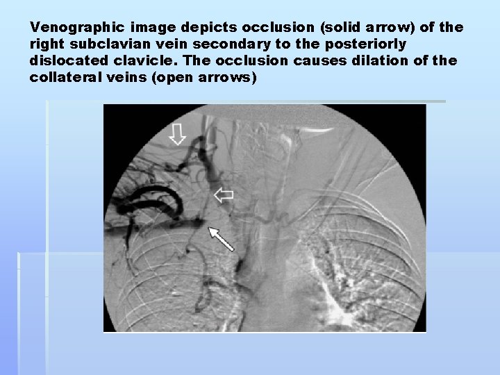 Venographic image depicts occlusion (solid arrow) of the right subclavian vein secondary to the