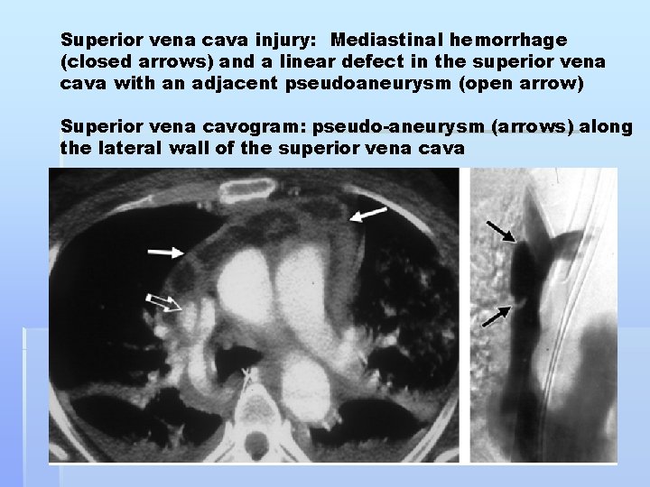 Superior vena cava injury: Mediastinal hemorrhage (closed arrows) and a linear defect in the
