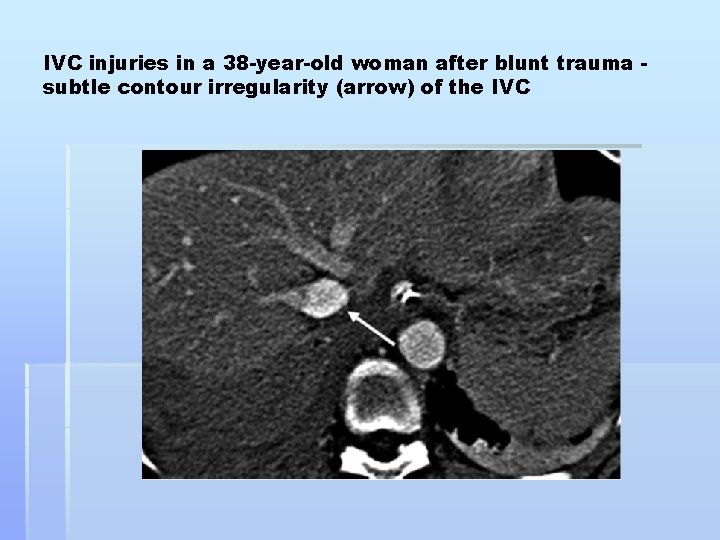 IVC injuries in a 38 -year-old woman after blunt trauma subtle contour irregularity (arrow)