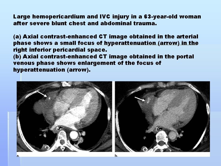 Large hemopericardium and IVC injury in a 63 -year-old woman after severe blunt chest