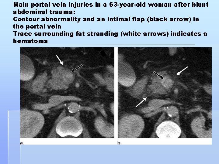 Main portal vein injuries in a 63 -year-old woman after blunt abdominal trauma: Contour