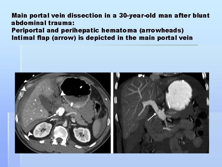 Main portal vein dissection in a 30 -year-old man after blunt abdominal trauma: Periportal
