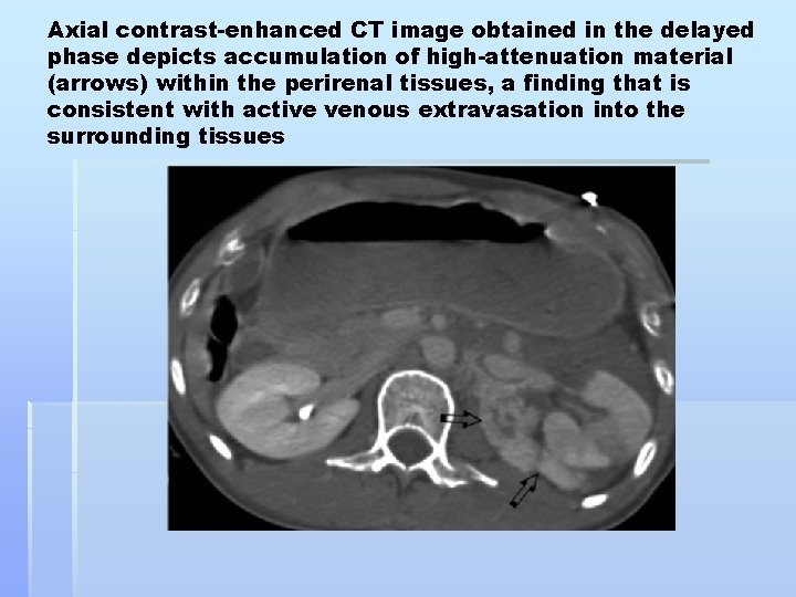 Axial contrast-enhanced CT image obtained in the delayed phase depicts accumulation of high-attenuation material