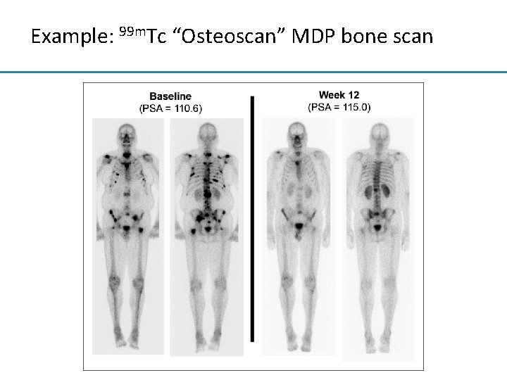 Example: 99 m. Tc “Osteoscan” MDP bone scan 