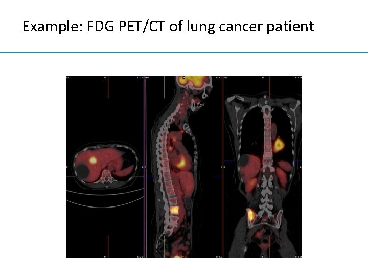 Example: FDG PET/CT of lung cancer patient 