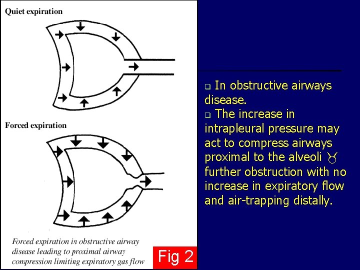 In obstructive airways disease. q The increase in intrapleural pressure may act to compress