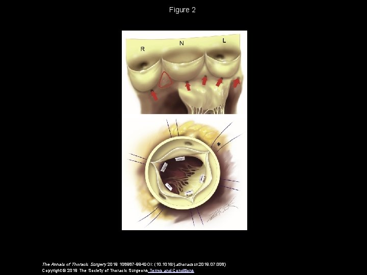 Figure 2 The Annals of Thoracic Surgery 2019 108987 -994 DOI: (10. 1016/j. athoracsur.