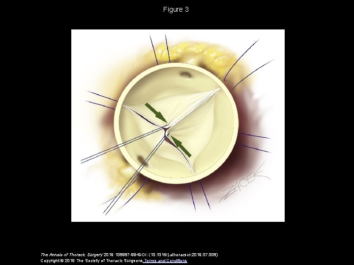 Figure 3 The Annals of Thoracic Surgery 2019 108987 -994 DOI: (10. 1016/j. athoracsur.