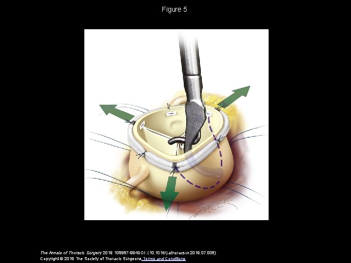 Figure 5 The Annals of Thoracic Surgery 2019 108987 -994 DOI: (10. 1016/j. athoracsur.