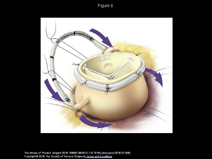 Figure 6 The Annals of Thoracic Surgery 2019 108987 -994 DOI: (10. 1016/j. athoracsur.