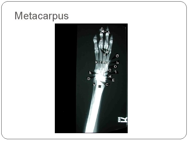 Metacarpus Metacarpus