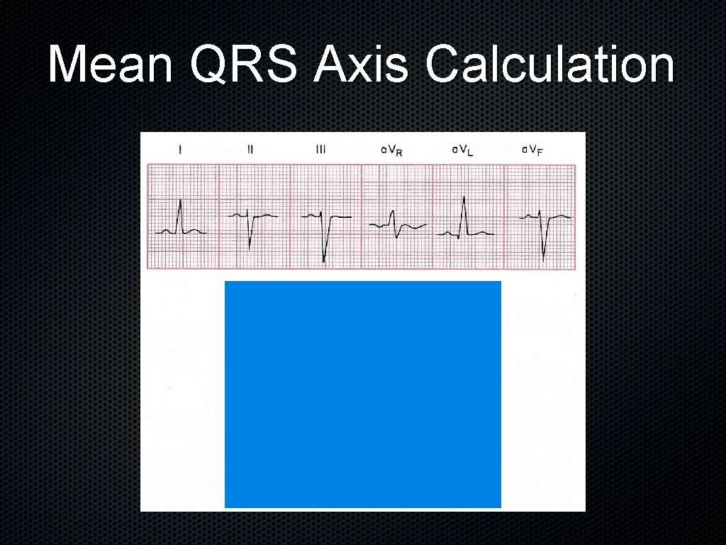 Mean QRS Axis Calculation 