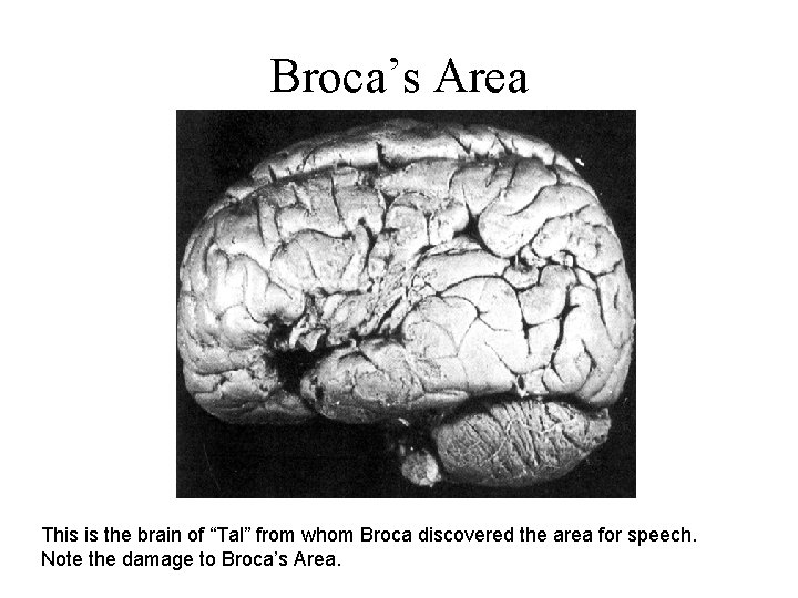 Broca’s Area This is the brain of “Tal” from whom Broca discovered the area