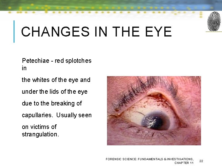 CHANGES IN THE EYE Petechiae - red splotches in the whites of the eye
