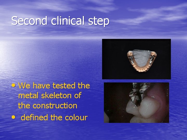 Second clinical step • We have tested the metal skeleton of the construction •