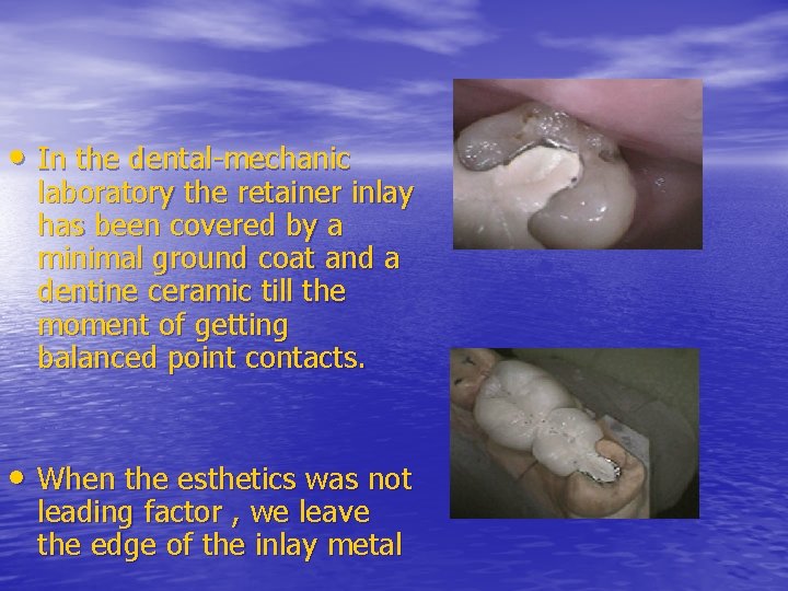  • In the dental-mechanic laboratory the retainer inlay has been covered by a