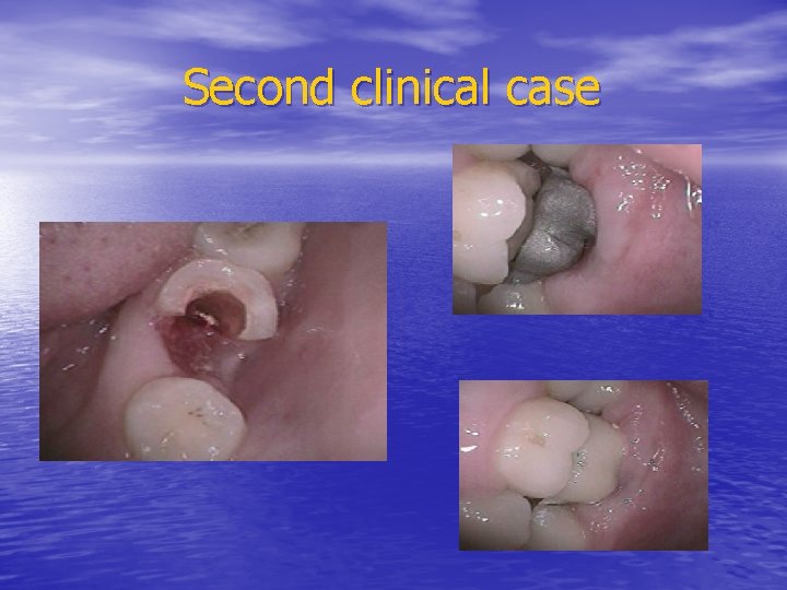 Second clinical case 