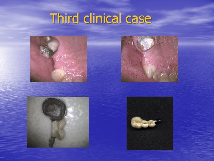 Third clinical case 