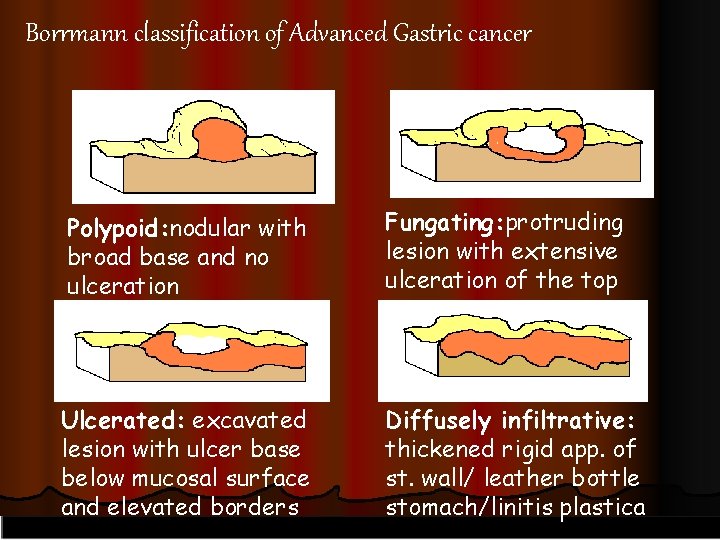 Borrmann classification of Advanced Gastric cancer Polypoid: nodular with broad base and no ulceration